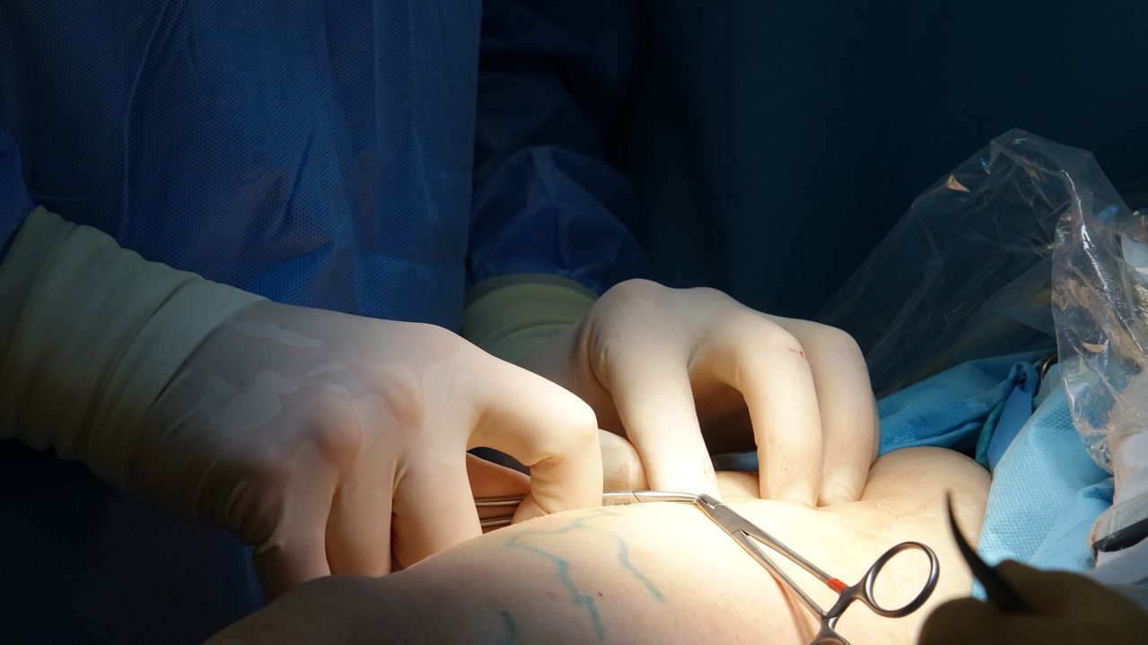 Penile Lengthening