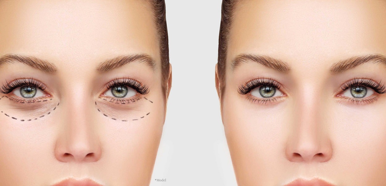 Blepharoplasty (Eyelid Surgery)