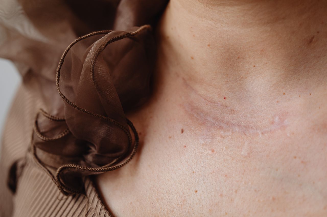 Scar Revision